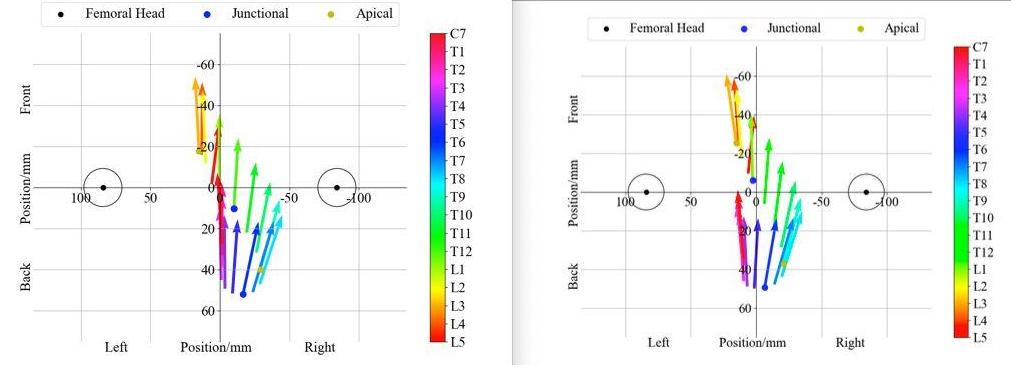 Vertebral rotation vector analysis before and after PAMO